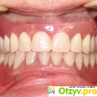 Какие съемные зубные протезы лучше поставить отзывы отзывы