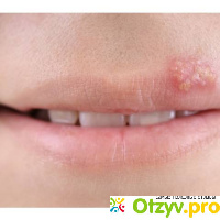 Пузырьки на губах: причины и лечение отзывы