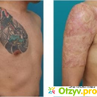 Rejuvi Tattoo Removal - биохимическое удаление татуировок отзывы