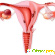 Как лечить эндометриоз матки -  - Фото 209359