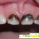 Серебрение молочных зубов -  - Фото 222567