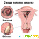 Полипэктомия матки -  - Фото 237014