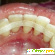 Шинирование зубов отзывы пациентов -  - Фото 336471