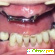 Имплантация зубов -  - Фото 374421