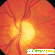 Атрофия глазного нерва лечение и прогноз -  - Фото 370752
