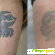 Rejuvi Tattoo Removal - биохимическое удаление татуировок -  - Фото 679535