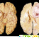 Опухоль мозга: симптомы на ранней стадии. Первые признаки опухоли мозга -  - Фото 679321