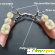 Съемные зубные протезы какие лучше отзывы -  - Фото 672461