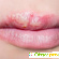 Пузырьки на губах: причины и лечение -  - Фото 679420
