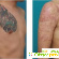 Rejuvi Tattoo Removal - биохимическое удаление татуировок -  - Фото 679534