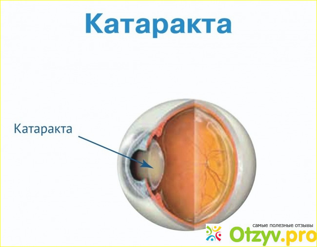 Что происходит во время хирургии катаракты?