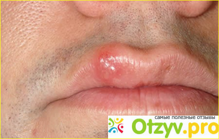 Как устранить вирус герпеса на губах