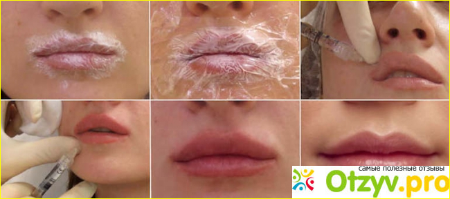 Увеличение губ Restylane отзывы, фото до и после