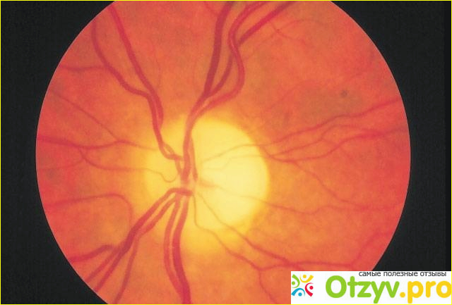 Атрофия глазного нерва лечение и прогноз фото1