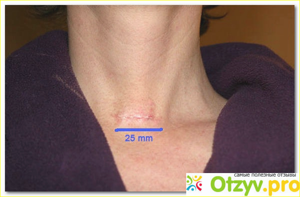 Удаление щитовидной железы отзывы форум фото1