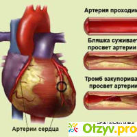 Ишемическая болезнь сердца отзывы