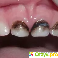 Серебрение зубов у детей отзывы