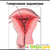 Гиперплазия эндометрия отзывы