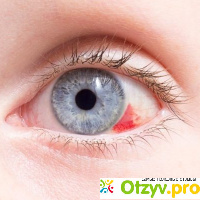 ?Кровоизлияние в глаз: причины, лечение. Что делать и как лечить ?кровоизлияние в глазу отзывы
