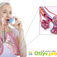 Лечение бронхиальной астмы народными средствами отзывы