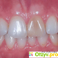 Почему многие запломбированные зубы становятся розовыми? отзывы