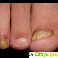 Лечение грибка ногтей на ногах препараты отзывы отзывы