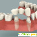 Что такое «мост» в стоматологии? Для чего в стоматологии используют «мост»? -  - Фото 418730