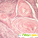 Плоскоклеточный неороговевающий рак шейки матки -  - Фото 491973