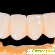 Зубные коронки из металлопластмассы -  - Фото 688240