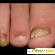 Лечение грибка ногтей на ногах препараты отзывы -  - Фото 963792