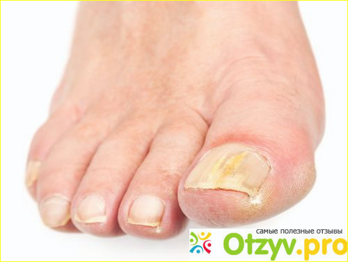 Грибок на ногтях ног лечение народными средствами фото1