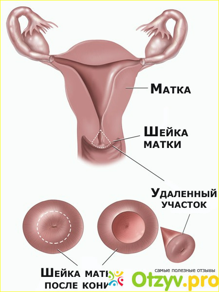 Беременность и роды после конизации шейки матки!