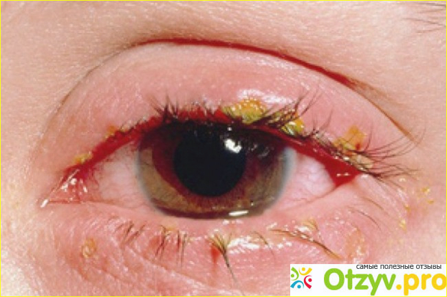 Причины и болезни, которые приводят к воспалению глаз