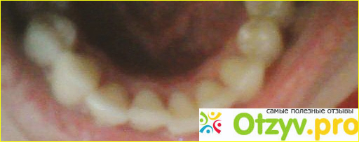 Чистка зубов ультразвуком фото1