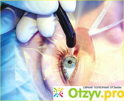 Отзыв о Лазерная коррекция зрения - операция
