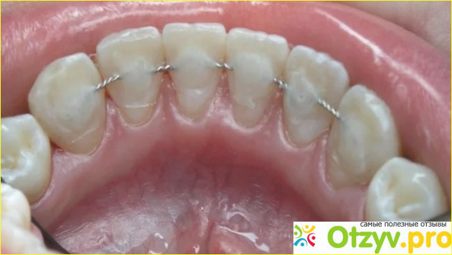 Отзыв о Шинирование зубов отзывы пациентов