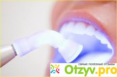 Лазерная чистка зубов