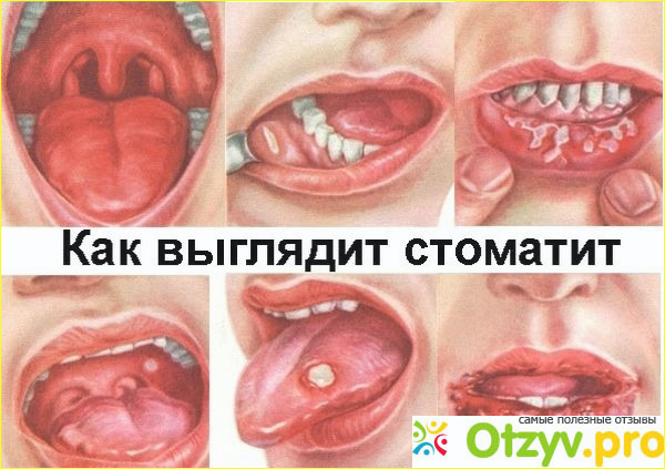Что представляют собой язвы во рту?