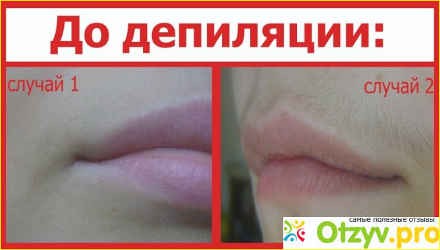 Эпиляция усов у женщин отзывы фото1