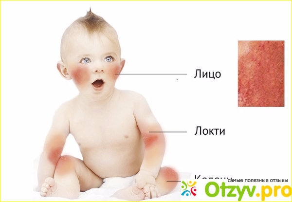 Гипоаллергенные смеси для новорожденных какая лучше отзывы фото1