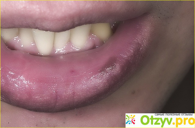 Почему синеют губы у взрослого человека: причины и лечение фото1