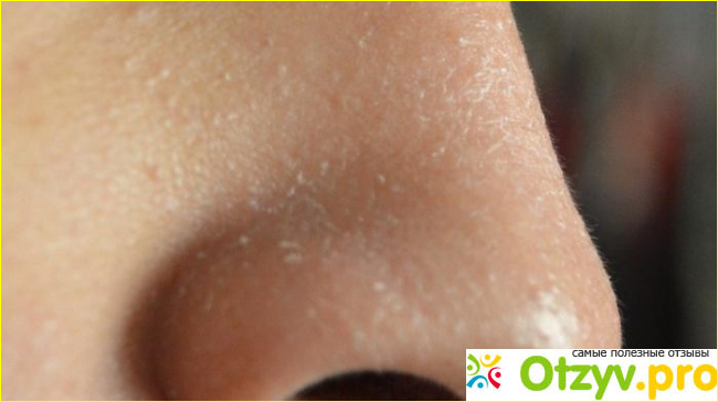 Отзыв о Если кожа на лице шелушится, что делать? Причины шелушения и способы его устранения
