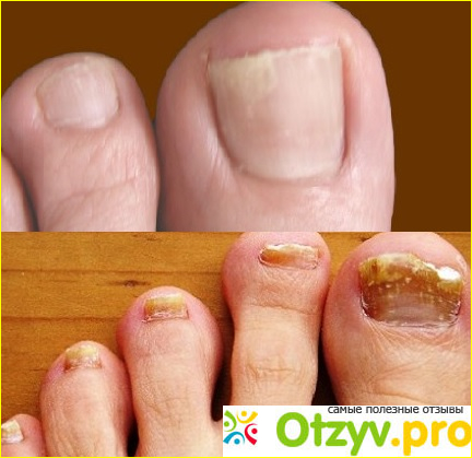 Лечение грибка ногтей на ногах препараты отзывы фото1